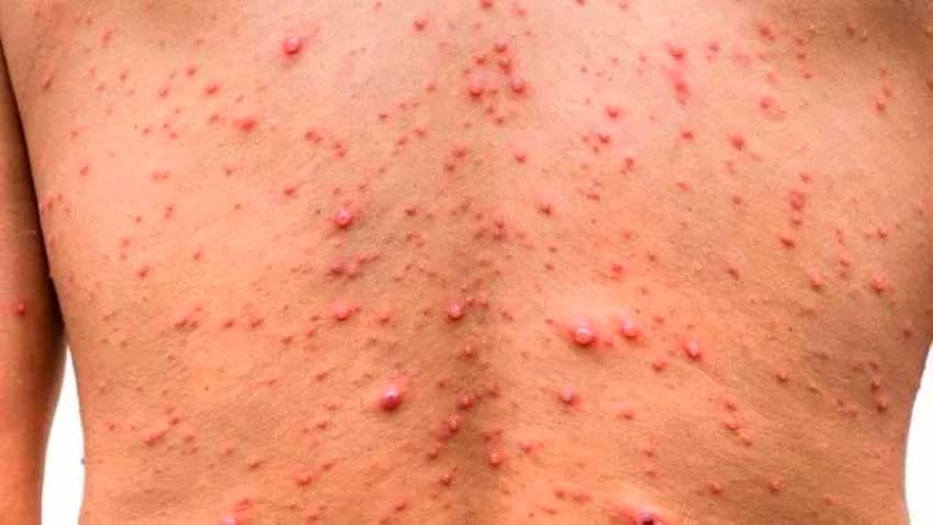 الحكومة تعلن رفع وتيرة الاستعداد لمنع انتقال فيروس جدري القردة