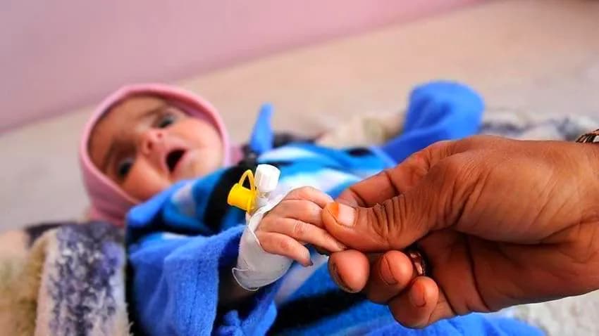 مسؤول أممي: نصف أطفال اليمن يعانون من سوء التغذية