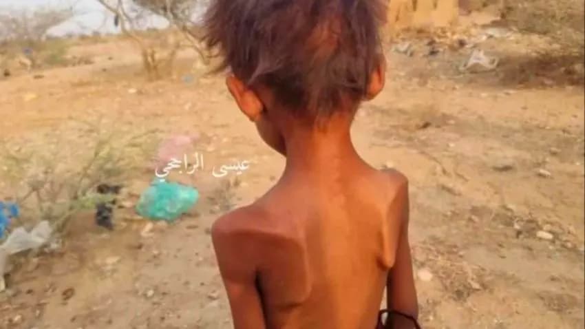 طفلة يمنية تفارق الحياة جوعاً وتكشف حجم الكارثة الإنسانية في مخيمات النزوح بحجة