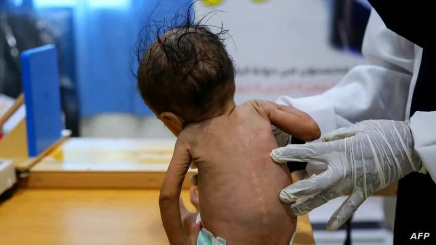 الأمم المتحدة: إصابة أكثر من 50 ألفا بالحصبة في اليمن هذا العام